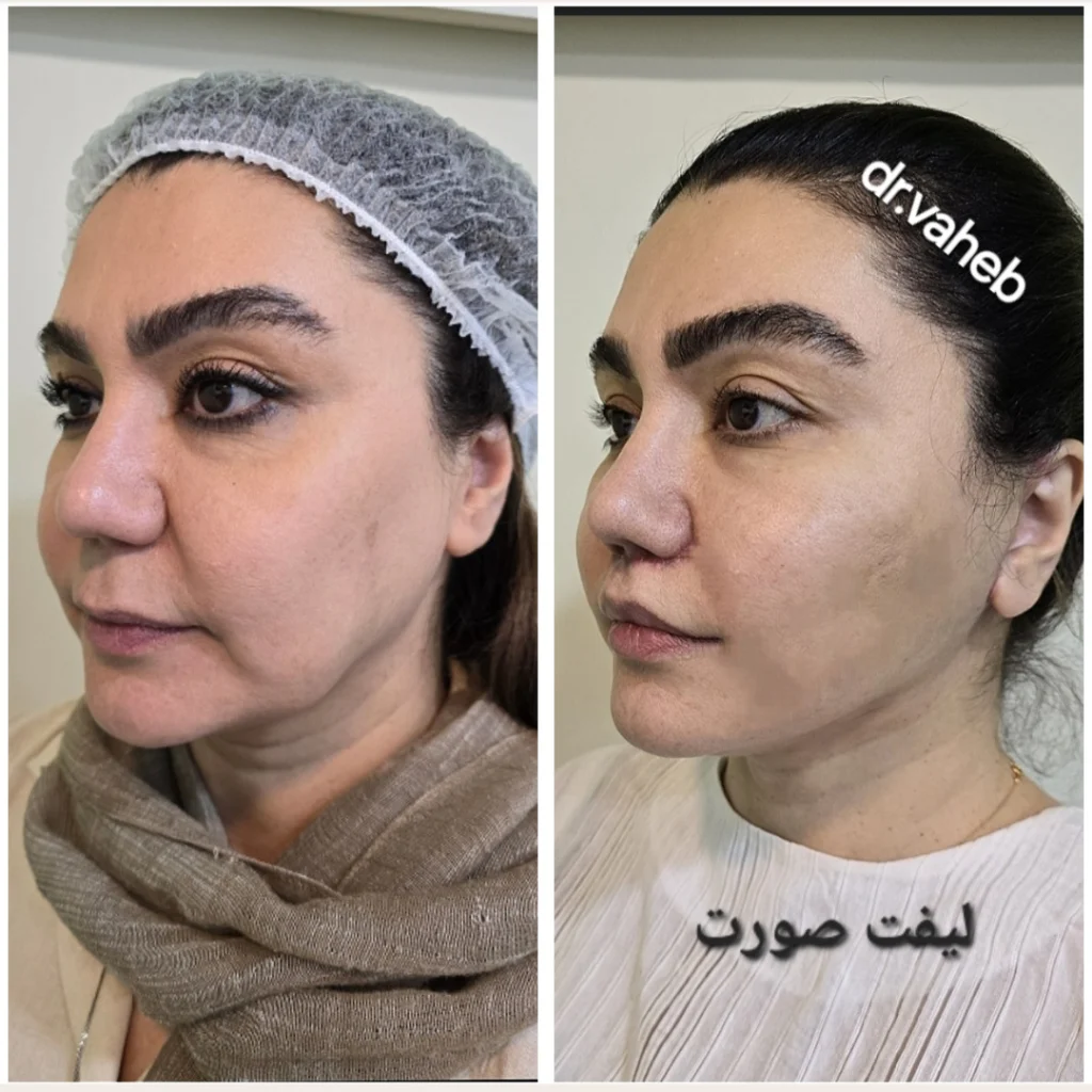نمونه کار دکتر واهب لیفت صورت