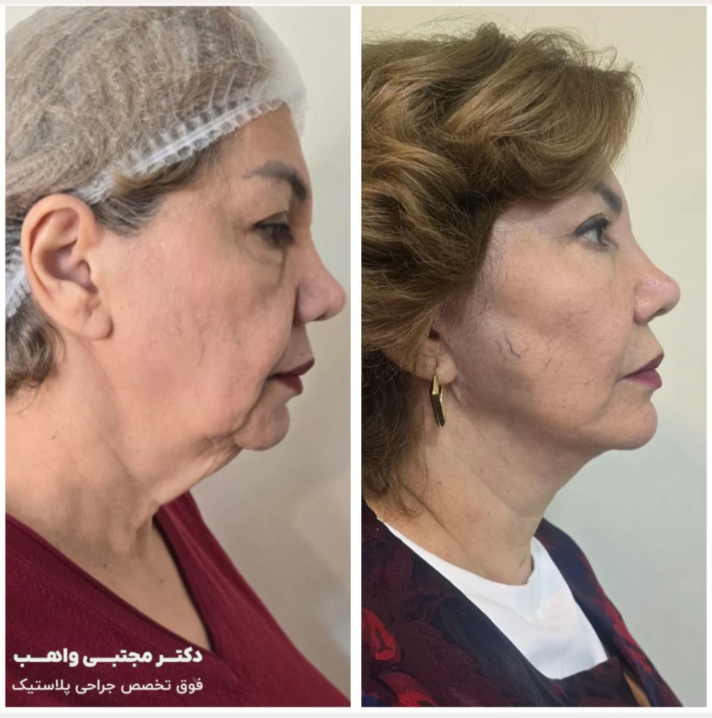 نمونه کار لیفت صورت دکتر واهب