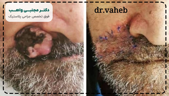 ایا با عمل جراحی بی سی سی سرطان درمان میشود