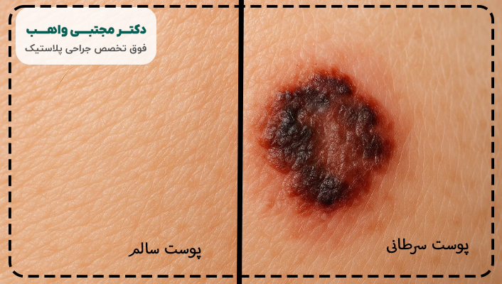 تصاویر سرطان پوست