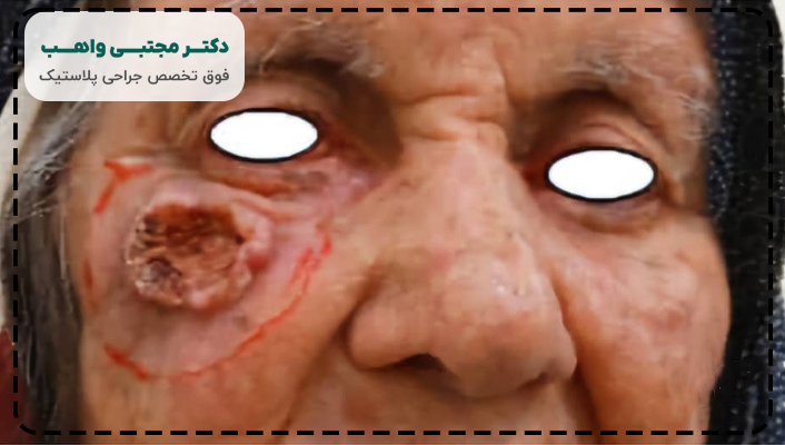 عکس سرطان سلول سنگفرشی