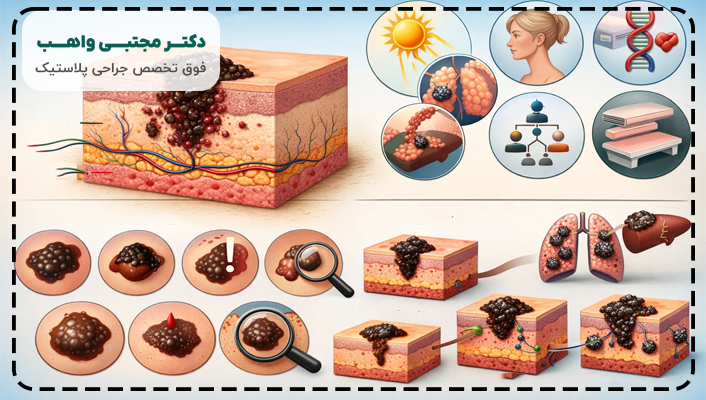 درمان سرطان ملانوم بدخیم