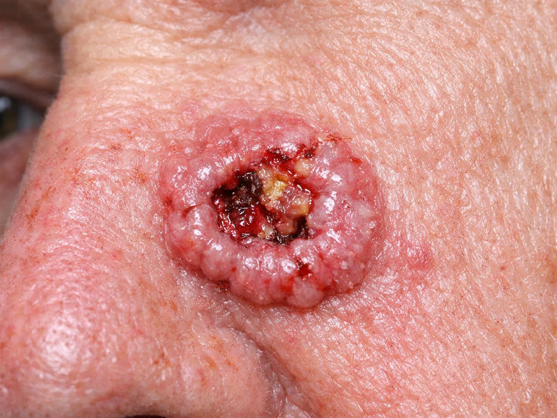سرطان سلول بازال