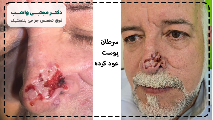 سرطان پوست عود کرده