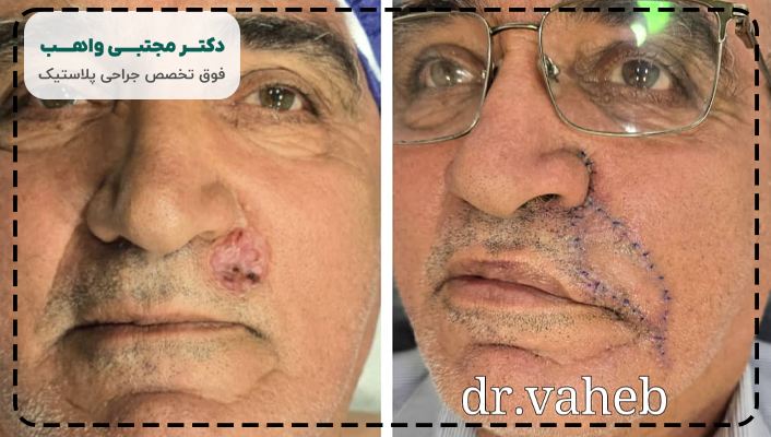 علائم سرطان سلول سنگفرشی