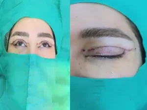 عمل بلفاروپلاستی پلک بالا