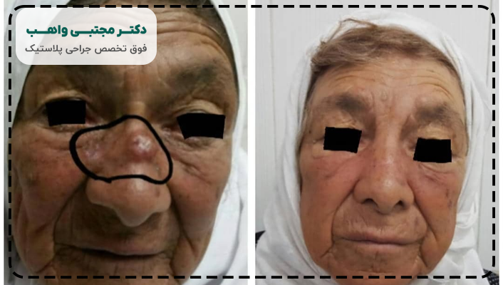 عکس سرطان سلول بازال