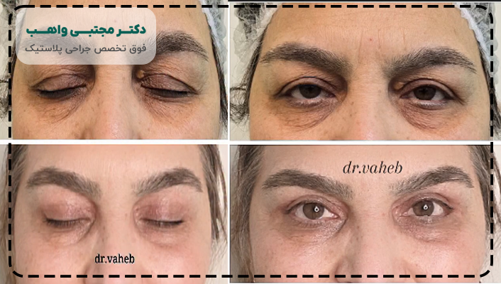 قبل از عمل بلفاروپلاستی چه بخوریم