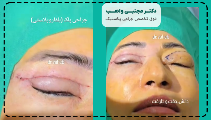 هزینه عمل افتادگی پلک