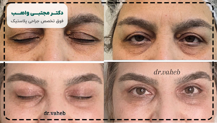 نمونه کار بلفارو پلاستی دکتر مجتبی واهب